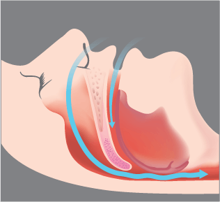 3 Snoring - Simple Sleep Services